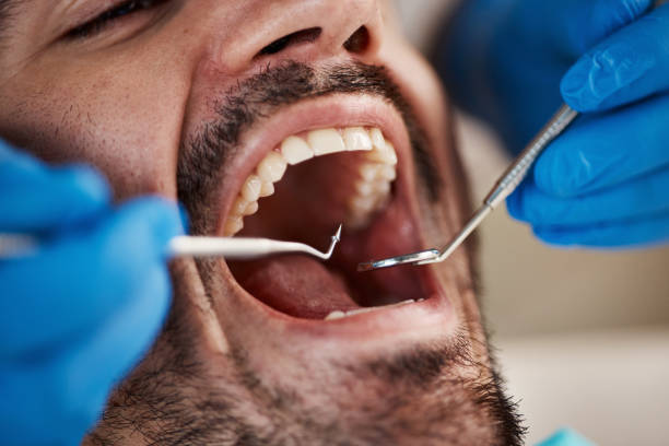 Best Emergency Tooth Extraction in Oronogo, MO