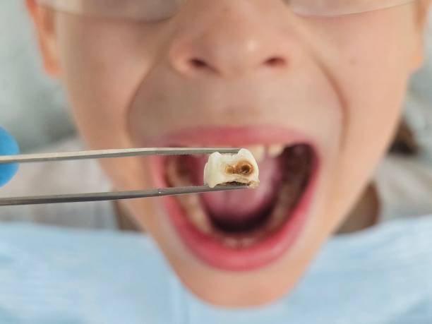 Best Same-Day Emergency Dental Services in Oronogo, MO